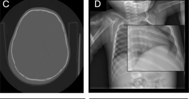 Fewer head injuries, not less abuse: COVID’s hidden toll