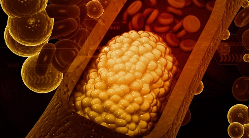 High cholesterol can be inherited. Here’s what you can do about it