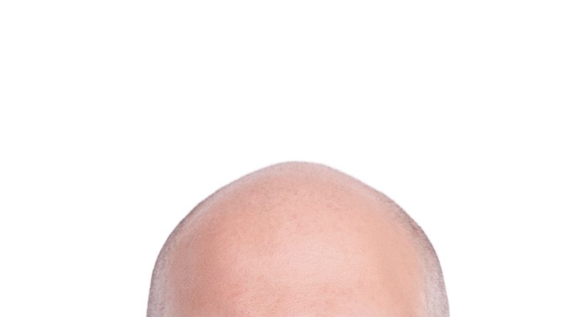 Sugary drinks linked to hair loss
