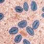 Mpox strain that may be more severe and easily spread is found in L.A. County for first time
