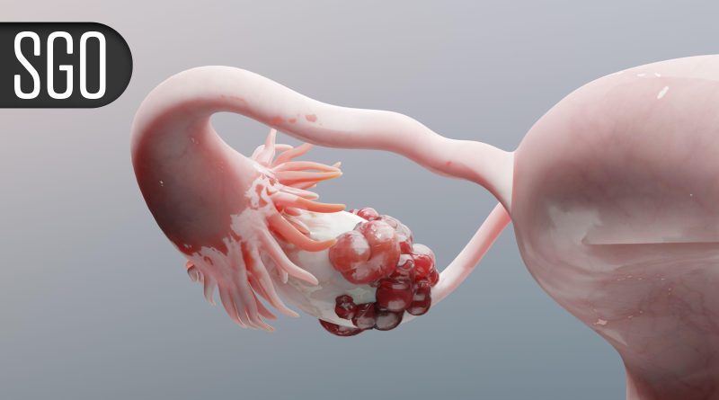 Novel Regimen Boosts Survival for Recurrent Platinum-Resistant Ovarian Cancer