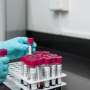 Blood biomarkers could detect earliest signs of Alzheimer’s disease—and slow its progression Blood biomarkers could detect earliest signs of Alzheimer’s disease—and slow its progression