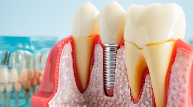 Researchers Solve the Mystery Behind a Billion-Dollar Dental Implant Disease